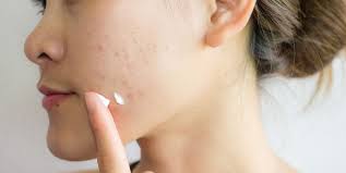 15 Best Acne Scar Treatment Products Top Acne Scar Removal Creams