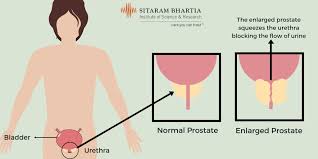 Prostate Enlargement Meaning Treatment Lifestyle Changes For Men