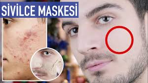 Cildim Mahvoldu Ve Sadece Bu Sivilce Maskesi Ile Puruzsuz Oldu Cilt Bakimi Youtube