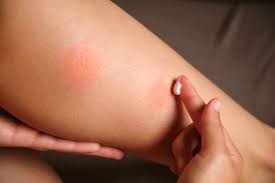 Image result for mosquito bite