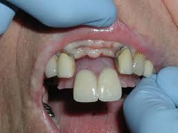 Can You Eat With Flipper Teeth Teethwalls