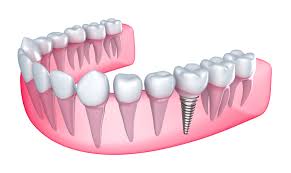 Rather, it is a partial acrylic denture that is designed to fill in a gap after an extraction. Parent S Guide Can Children Get Dental Implants Dr Paulo Pinho