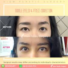 Something that will at least temporarily decrease the swelling of excess eyelid skin. Just 5 Days After The Surgery Her Eyes Already Look Awakened And Wide Open Double Eyelid Surgery Cosmetic Procedures Plastic Surgery