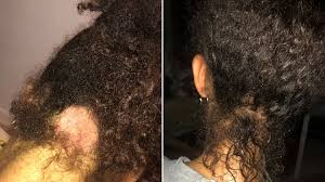 Understanding the condition this is a skin condition that causes red patches on your skin and flaking. Woman Creates Afro Hair Care Brand To Help With Her Scalp Psoriasis Metro News