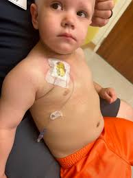 Today Maverick had his 17th and LAST lumbar puncture. He also got his last  dose of vincristine, the chemo that is administered through his port. He  will still take his chemo pills