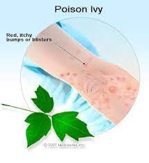 One of the most effective tips on how to treat poison ivy on face and lips naturally is using turmeric powder. How To Get Rid Of Poison Ivy Oak Sumac Rash Treatment Pictures