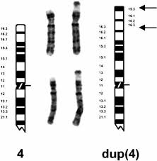 The deletion occurs in one chromosome, most often as a random event during the formation of reproductive cells (eggs or sperm) or in early fetal development. Loss Of Subtelomeric Sequence Associated With A Terminal Inversion Duplication Of The Short Arm Of Chromosome 4 Cotter 2001 American Journal Of Medical Genetics Wiley Online Library