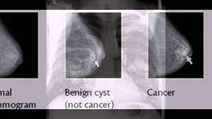 Then looking at the abnormality, try to determine if it looks like a malignancy or benign tissue. Breast Cancer X Ray Youtube