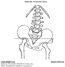 Image result for Functional Leg Length Discrepancy