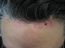 Celiac Disease Gluten Sensitivity And Skin Issues