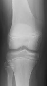 Answering what does bone cancer pain feel like can be difficult, as the pain can vary between each individual. Orthokids Osteochondroma