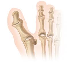 Image result for Hallux Varus