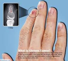 what is glomus tumor how is it treated