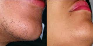Prices for laser hair removal. Laser Hair Removal Kuala Lumpur Malaysia Cost Reviews Benefits Nexus Cllinic