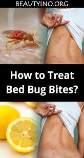 how to treat bed bug bites bed bug bites bed bug bites remedies bed bug bites treatment