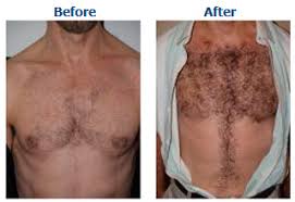 The results of you are wondering about how long this topical treatment takes to work, but did you know there are a few. Nathan Drake S Chest Hair Blows Realistically In The Wind In Uncharted 4 Ign Boards