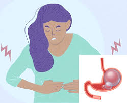 Image result for Flatulence