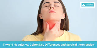 Image result for Goiter