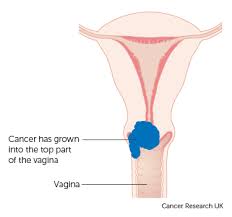 Although women often think bleeding is normal spotting, it's important to see your doctor if you experience: Stage 2 Cervical Cancer Cancer Research Uk