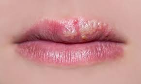 Herpes results from infection with the herpes simplex virus (hsv). Here S What You Need To Know About Cold Sores And Herpes