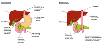Surgery is the most common treatment for stomach about 2,200 people are diagnosed with stomach cancer each year in australia. Myths And Facts About Stomach Cancer Canadian Cancer Survivor Network