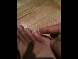 Pinky Toe Nail Falls Off Youtube There are many causes of black or dark toenails, but the most common cause is trauma.