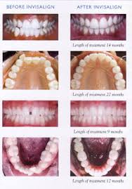 There are a few reasons why someone might choose traditional braces over invisalign. Invisalign Las Vegas 89129 Streamline Dental Solutions