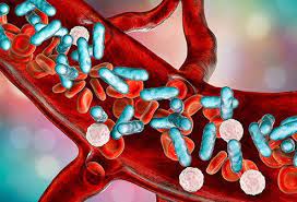 It is caused by the body's response to an infection. Sepsis Septicemia Diagnosis Causes Treatment Symptoms