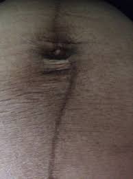 Dark Stomach Blackened Belly Button Babycenter