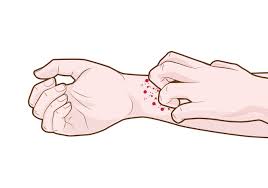 A psoríase invertida, também conhecida como psoríase inversa, é um tipo de psoríase que provoca o surgimento de manchas vermelhas na pele, especialmente na região das dobras, mas que. Psoriase O Que E Sintomas Causas Diagnostico E Tratamentos Veja Saude