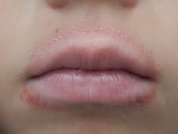 Windburn is caused by your body's response to cold, dry air. Lip Licker S Dermatitis Wikipedia