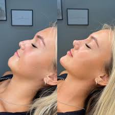 LIPS & CHIN ✨ By Bethany. Want these kind of natural tweaks? We're the  injectors for you🙋🏻‍♀️ We specialise in facial harmony, so if that's what  you're after, natural tweaks… we got