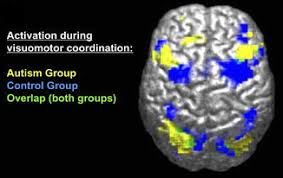 The autism spectrum encompasses a range of neurodevelopmental conditions, including autism and asperger syndrome, generally known as autism spectrum disorders (asd). Autism Insights From The Study Of The Social Brain Noba