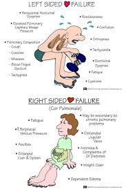 Image result for Right Heart Failure