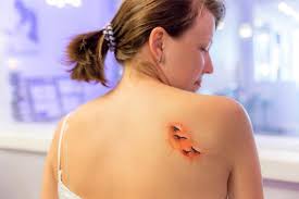 You can also use a tattoo numbing cream if you're really struggling. Infected Tattoo Symptoms Lovetoknow