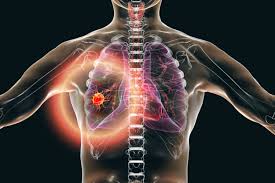 When lung cancer does cause signs in its early stages, they may vary from person to person but commonly include Non Small Cell Lung Cancer Nsclc News Articles Etc European Pharmaceutical Review