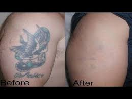 Want to discover art related to bodymodification? Tattoo Removal Sf Laser Tattoo Removal In San Francisco Youtube
