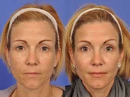 Non Surgical Facelifts For Women Over 50 Non Surgical Procedures Before After Gallery W Cosmetic Surgery