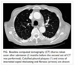 Pleural plaques viewed en face can simulate lung disease. More Compatible With Cryptic Miliary Tuberculosis Hkmj