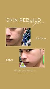 Achieve Scar-Free Skin with Willis Medical Aesthetics