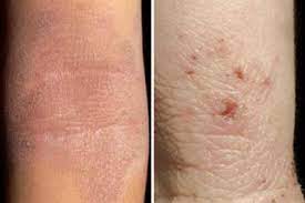 The efficacy of topical timolol for the treatment of recalcitrant fissures and erosions in patients with chronic hand eczema was supported in a short communication published in the journal of the. Clinical Review Atopic Eczema Gponline