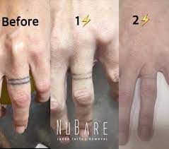This is the most common and popular way to remove a permanent tattoo. How Finger Tattoo Removal Happens Nubare Laser Clinic
