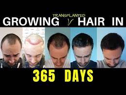 Pin By Gabiche On Fue Hair Transplant Results Hair Transplant Cost V Hair
