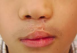 Bayi yang baru lahir baik melalui melahirkan normal atau caesar memiliki resiko terkena infeksi yang sangat besar. Bibir Sumbing Gejala Penyebab Dan Mengobati Alodokter