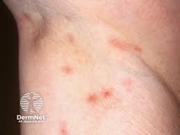 Image result for scabies on genitals