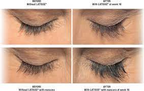 Only use the sterile applicators supplied with latisse ® to apply the product. Latisse Online Prescription Canada Eyelash Serum Certified Reseller