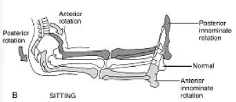 Image result for Functional Leg Length Discrepancy