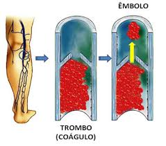 El trombo arterial o trombo blanco (rico en plaquetas) tiene un papel fundamental en el desarrollo de la placa de ateroma, característica que define a la aterosclerosis y a sus enfermedades derivadas, sobre todo a nivel cardíaco, cerebral y de la circulación periférica Que Es La Trombosis Salud Ayuda