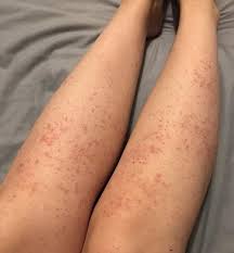 This is a situation where a hair on the human body curls or grows completely under your skin. Razor Bumps And Ingrown Hair Intimd