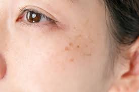 Image result for Hyperpigmentation